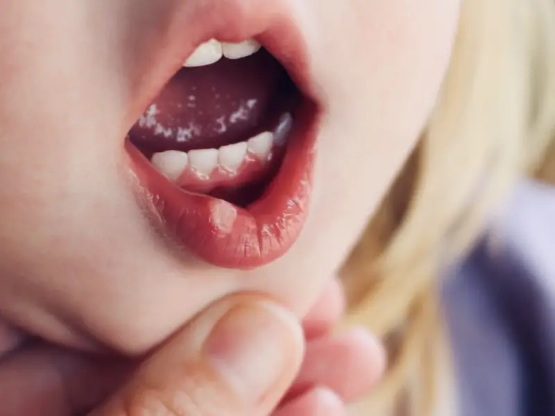 تبخال دهانی در کودکان