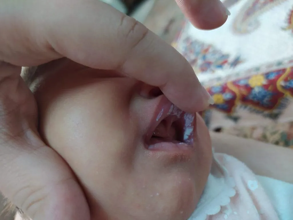 علت خوب نشدن برفک دهان نوزاد