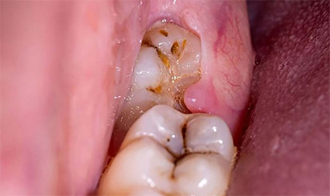 کشیدن دندان عقل بدون درد؛ آیا واقعا نیاز به نگرانی هست؟